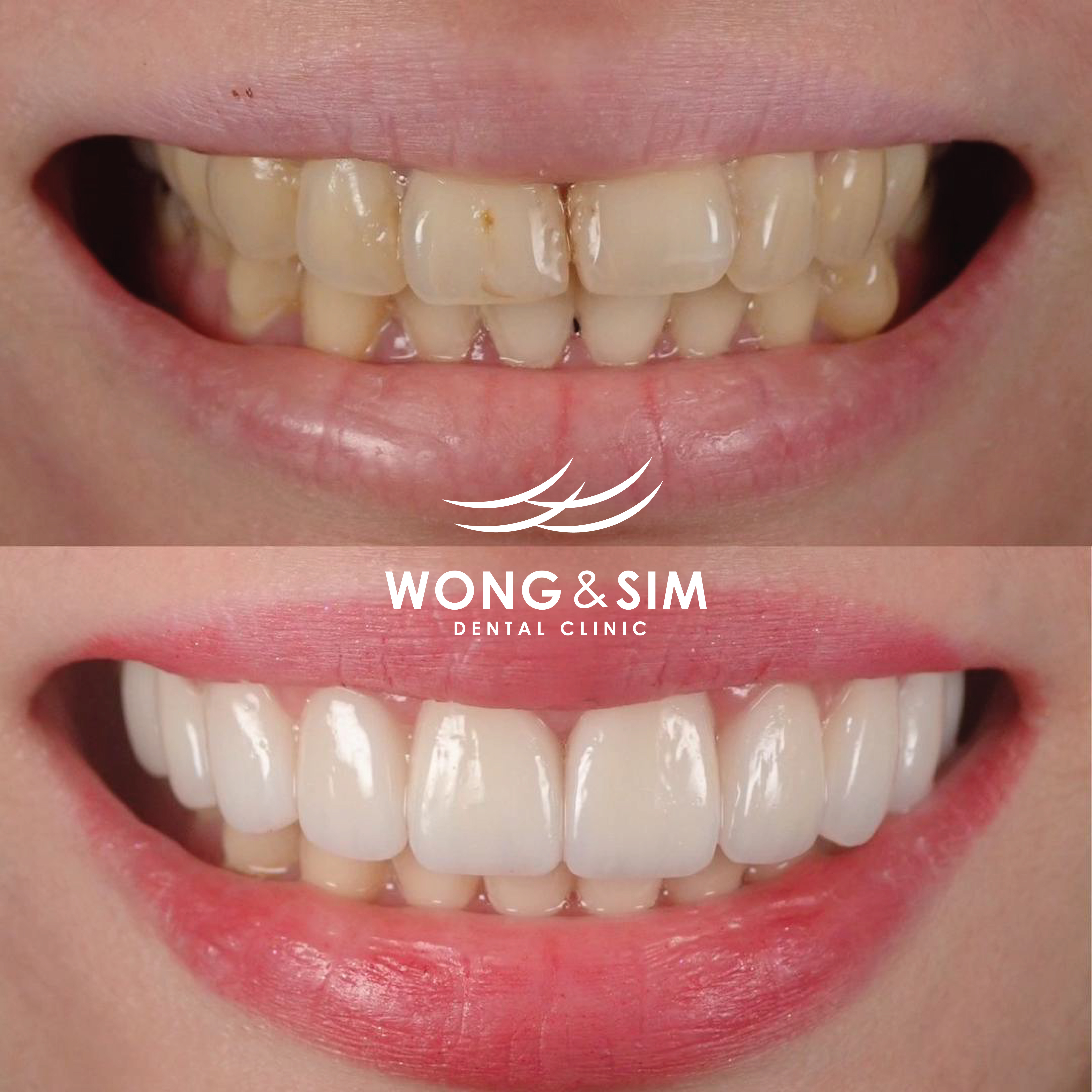 Implant Patient 9
