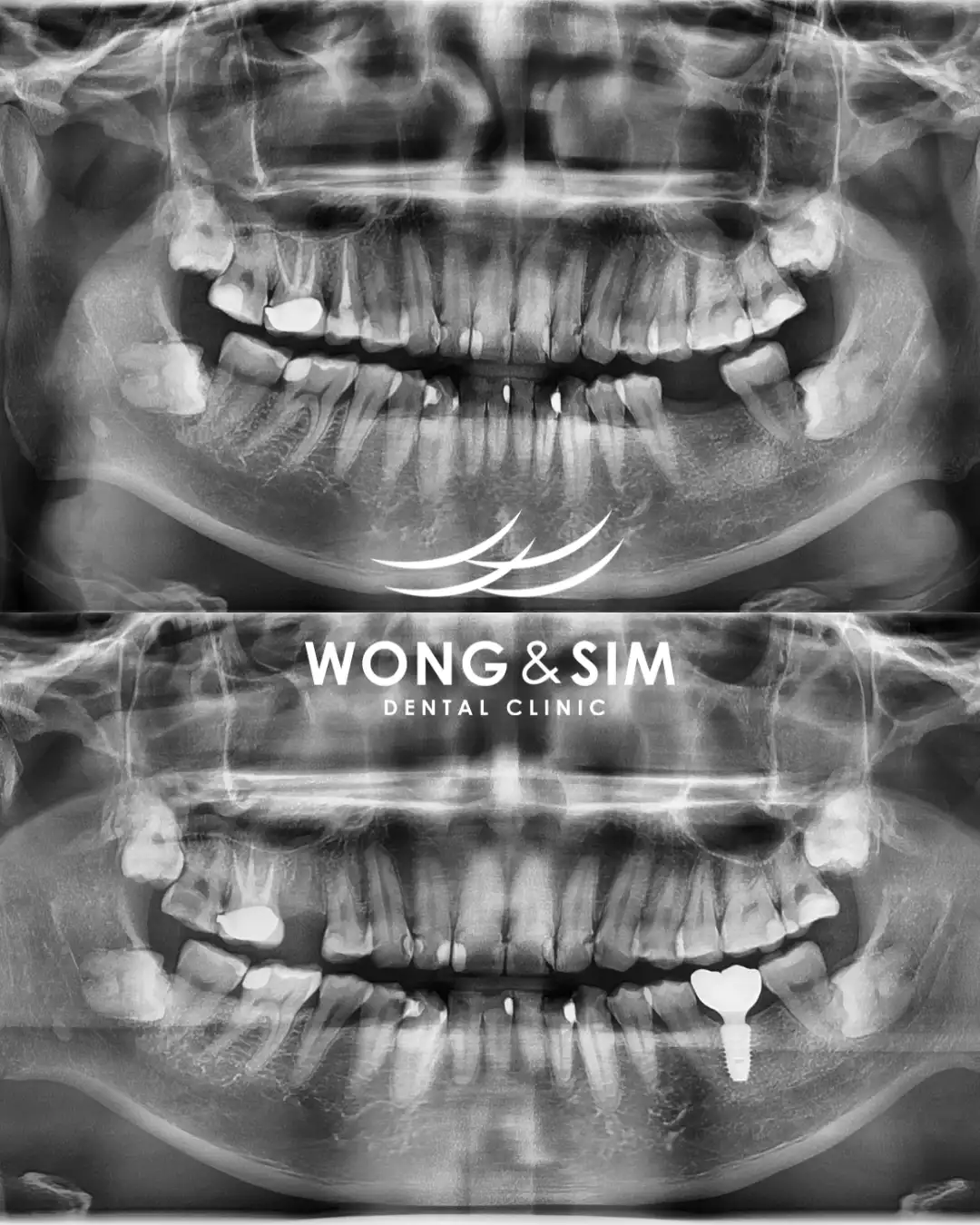 Implant Patient 2